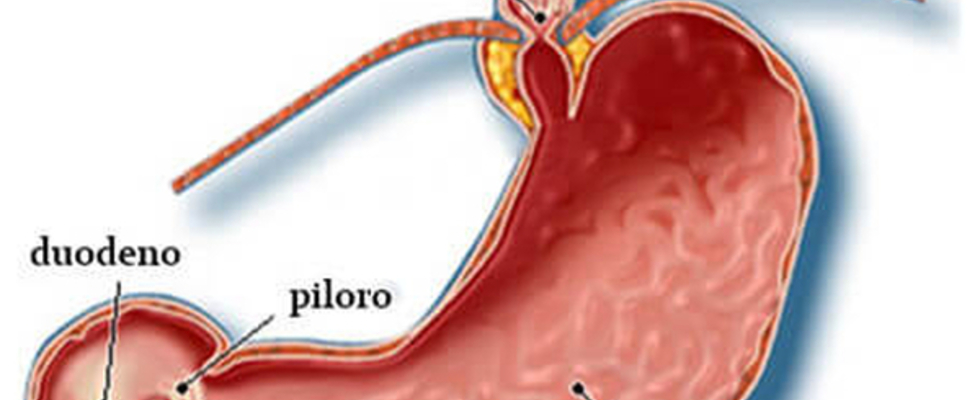 Cirurgia do Refluxo Gastroesofágico Dr Guines Alvarez