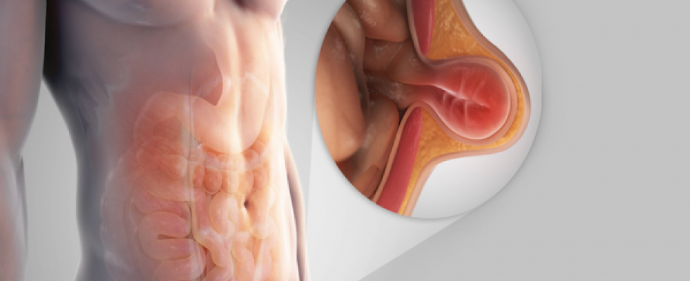 4 dicas para prevenir o surgimento da hérnia inguinal - Dr. Douglas Bastos  – Cirurgia do Aparelho Digestivo │Hepatobiliar